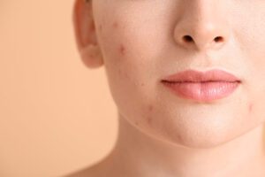 Riscos da acne: bactéria pode causar complicações graves ao entrar na corrente sanguínea